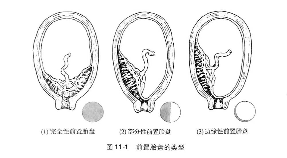 你问我答 之 胎盘低置怎么办?