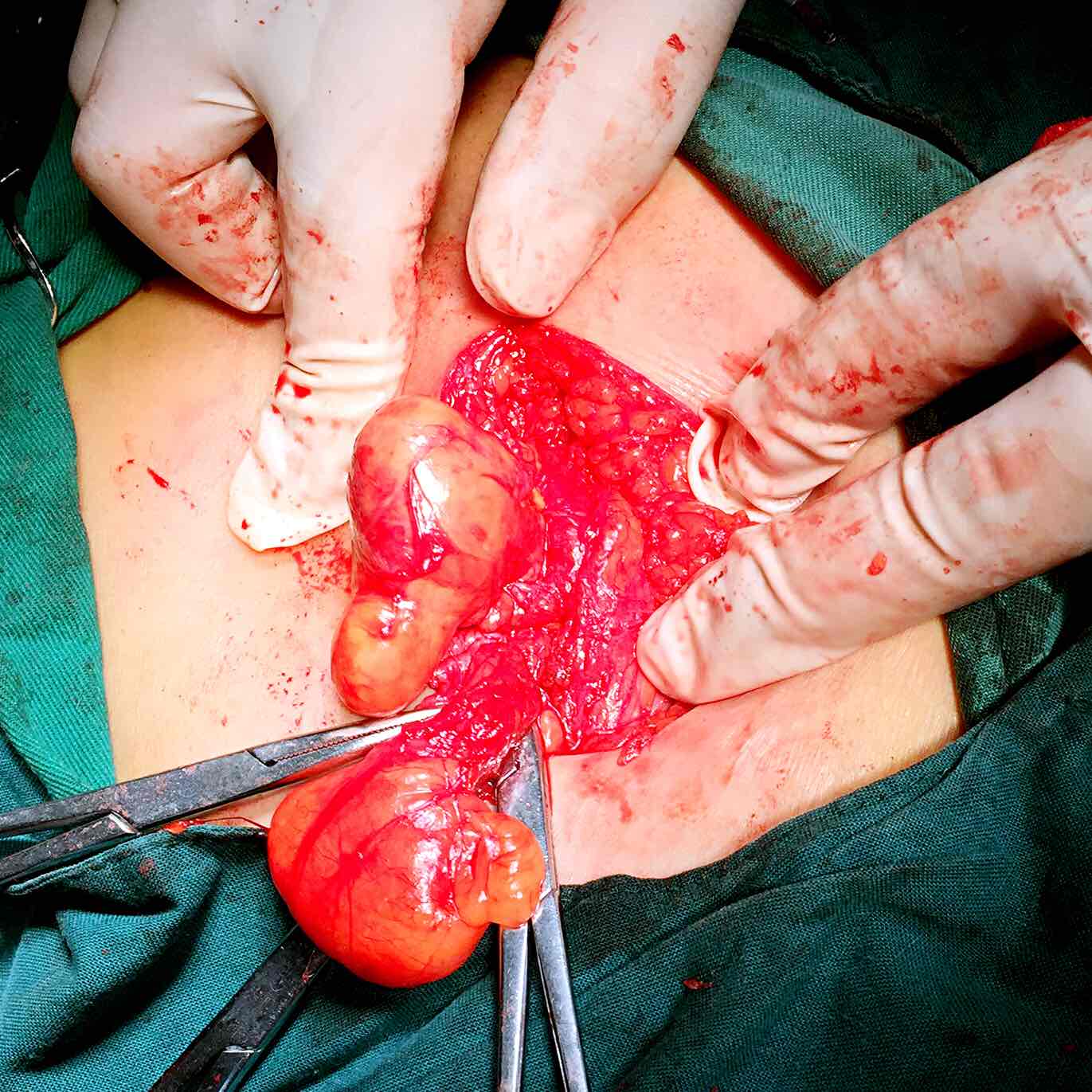 女性也有疝气,多数是股疝,今天有一个股疝嵌顿的女性患者,还好疝内容