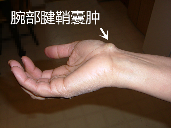 腱鞘囊肿容易生长在哪些部位呢?