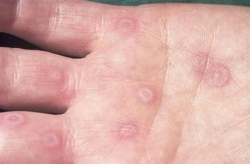 多形红斑,你比五环少两环!