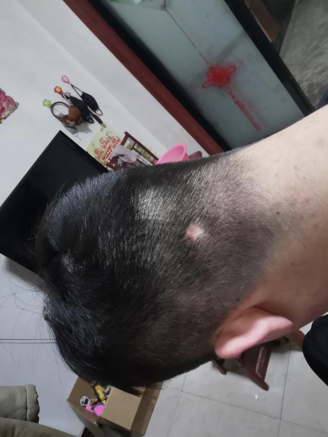 这是一种少见的头部慢性化脓性皮肤病,本病常与聚合性痤疮和化脓性