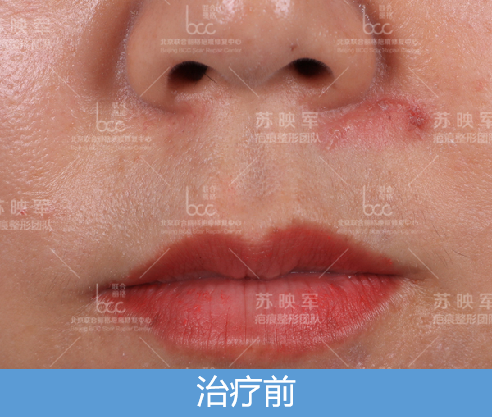 面部受伤留疤痕非手术疗法还原完好肌肤