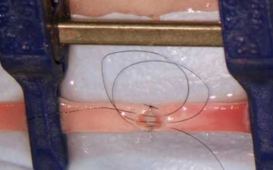 单股线怎么缝外科手术缝合线留在体内，会对人体有很大的影响吗？_https://www.jmylbn.com_新闻资讯_第5张