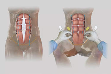 腹肌成型过程图片图片