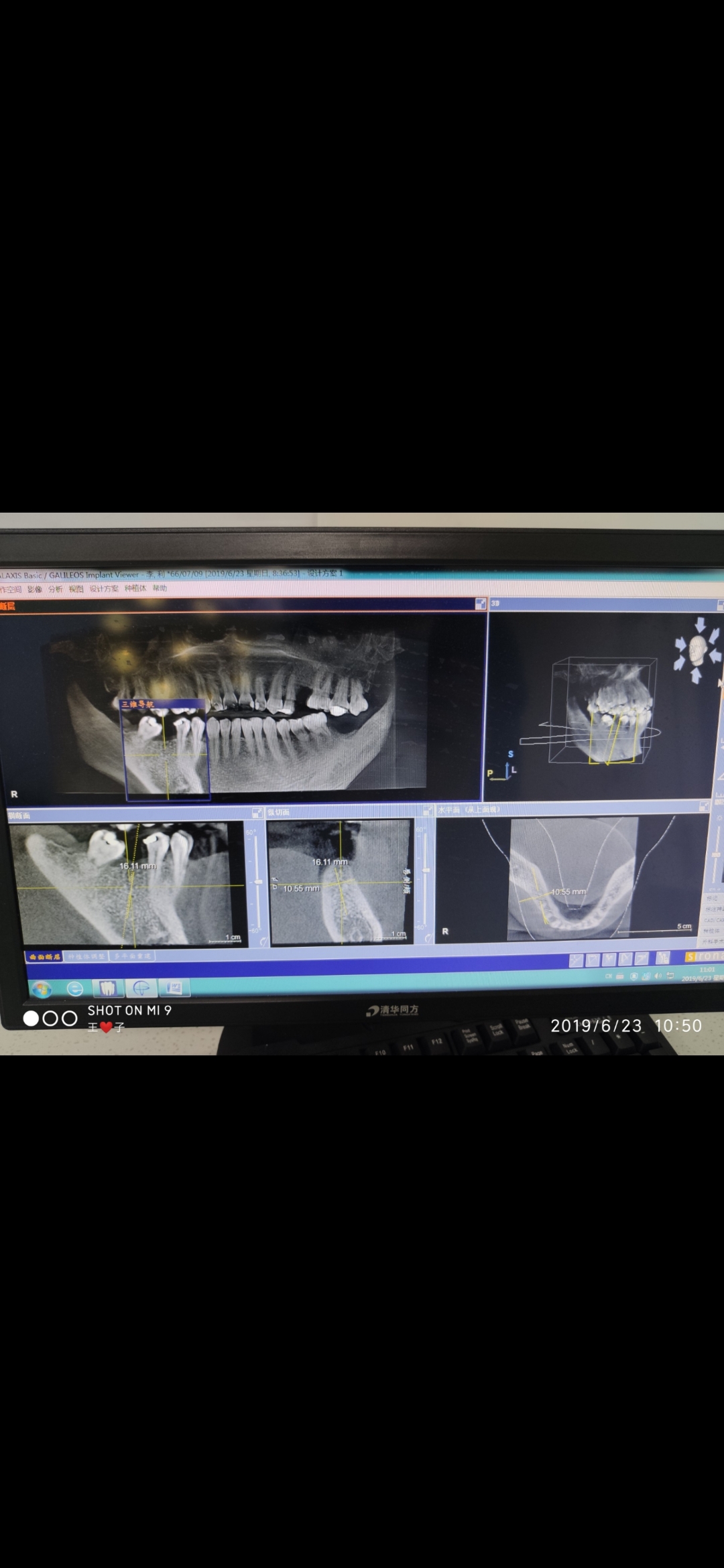 曲面断层片怎么看牙科影像学检查和作用（孕期能否拍摄？）_https://www.jmylbn.com_新闻资讯_第4张