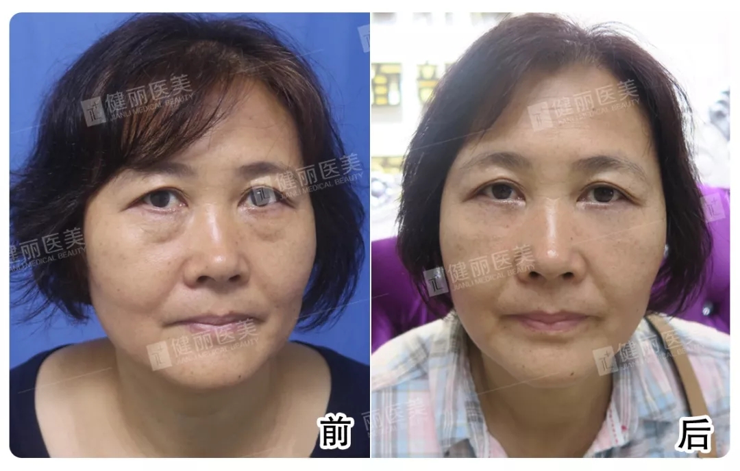 眼袋,早去除早年轻!