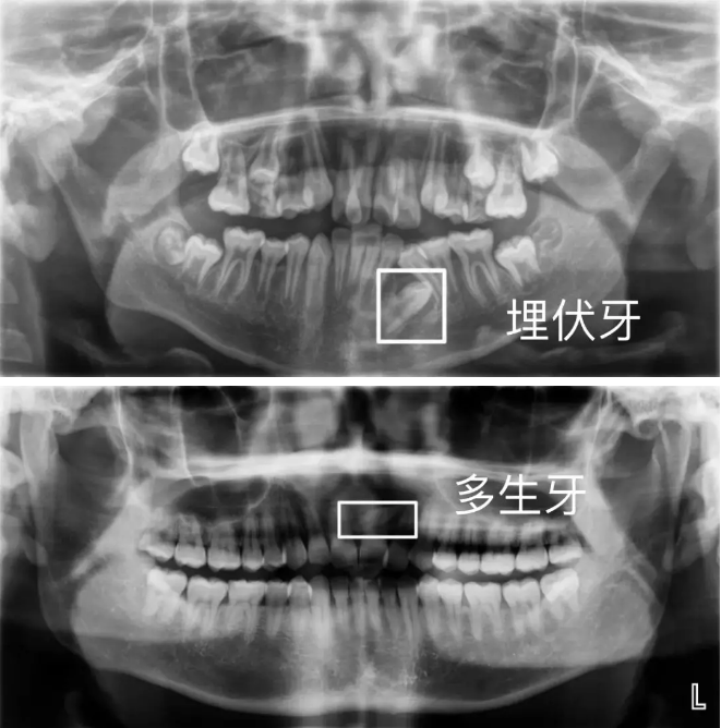 其次,全景片还能显示阻生牙,埋伏牙和恒牙缺失等牙齿异常