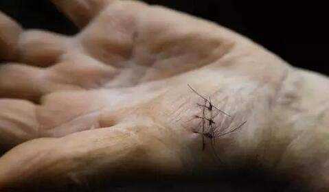 单股线怎么缝外科手术缝合线留在体内，会对人体有很大的影响吗？_https://www.jmylbn.com_新闻资讯_第6张