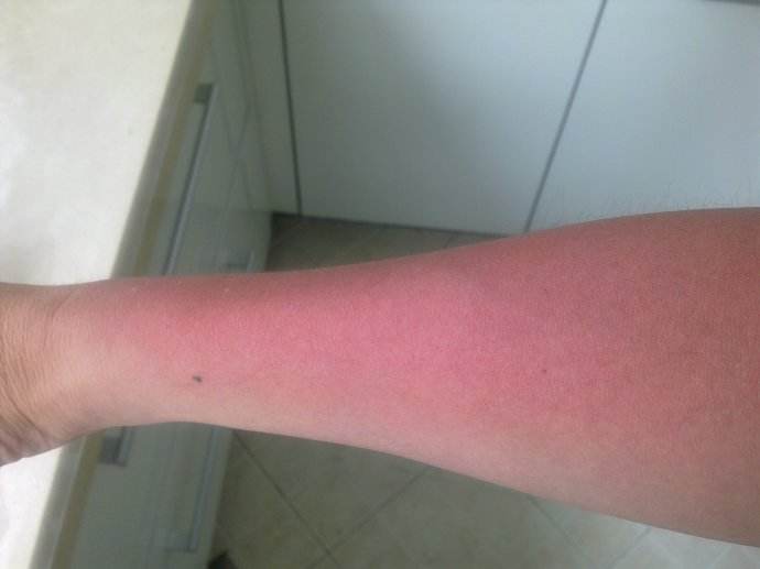 炎炎夏日,晒伤了要怎么做晒后修复?_郭春英_主治医师_爱问健康