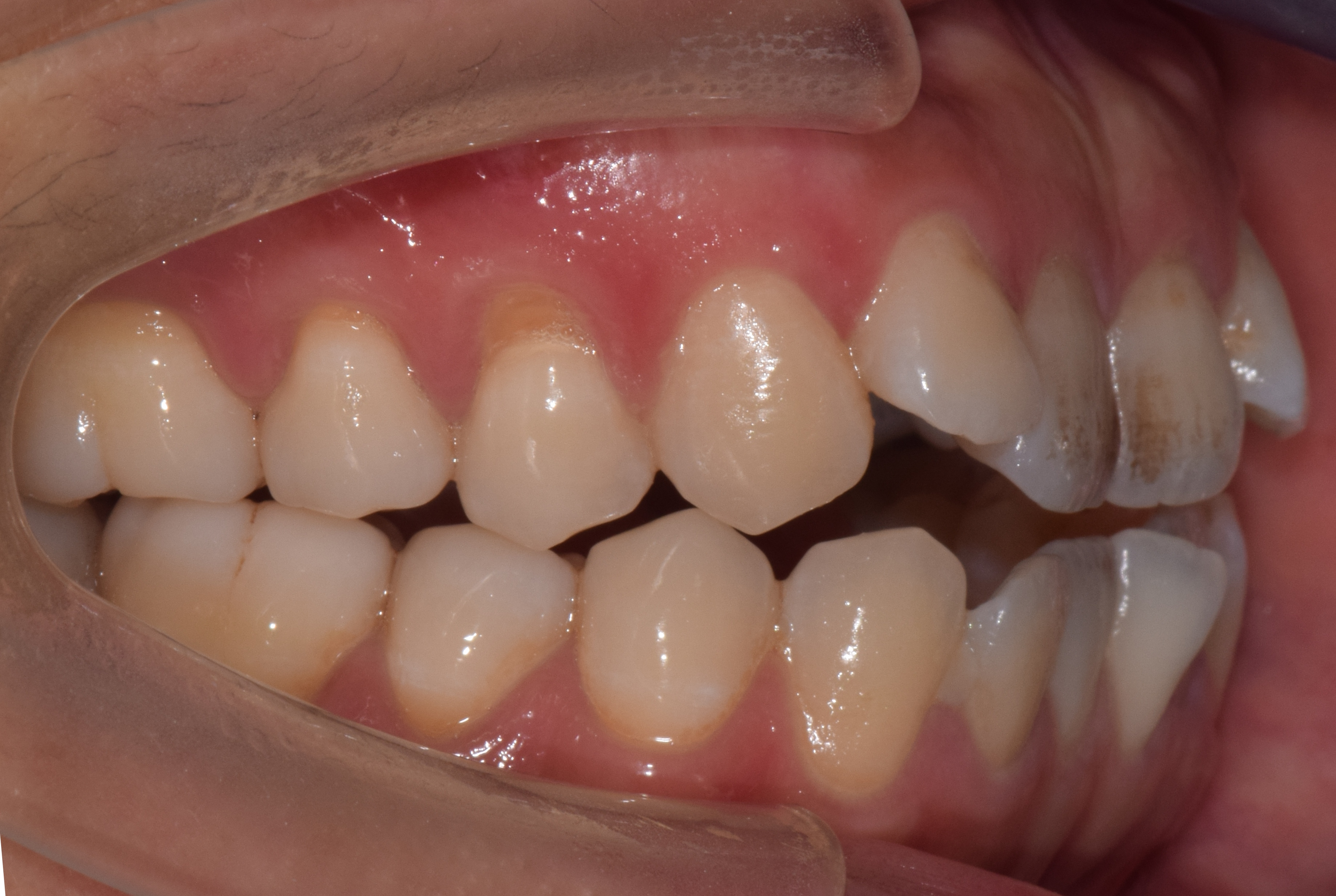 开颌矫正第一招:压低后牙,前旋下颌_梁爱燕_主治医师_爱问健康