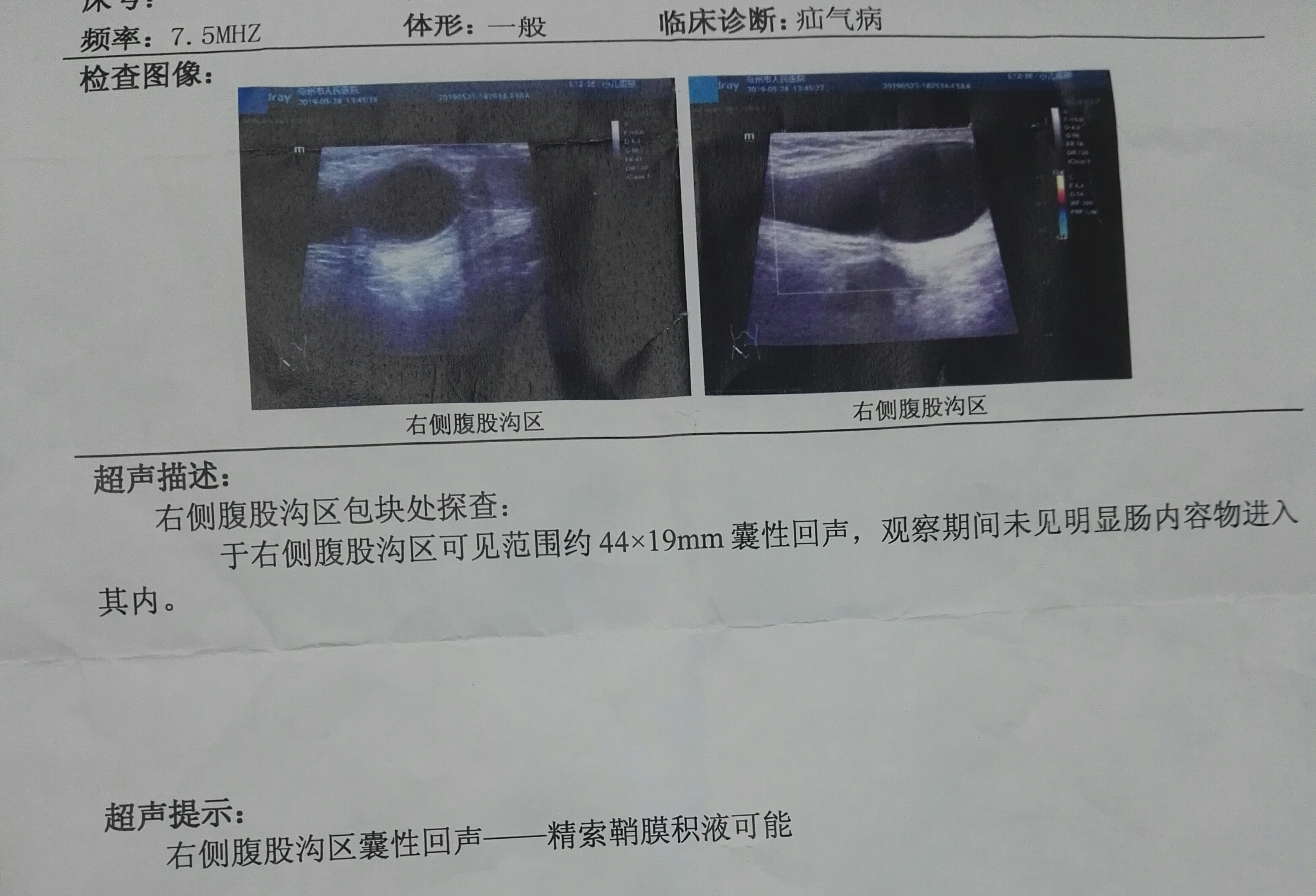 腹股沟斜疝彩超图片图片