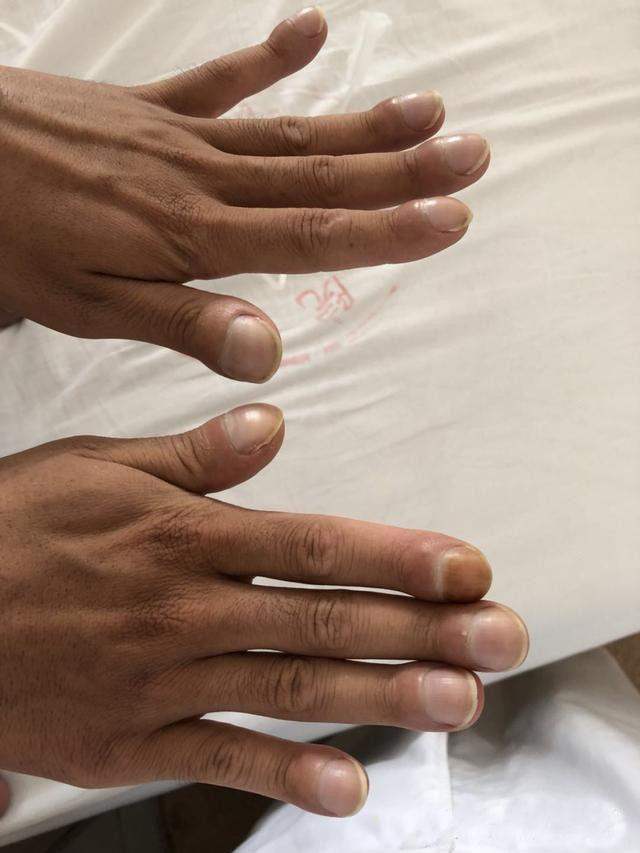 杵状指:手指或足趾末端增生,肥厚,增宽,增厚,指甲从根部到末端拱形