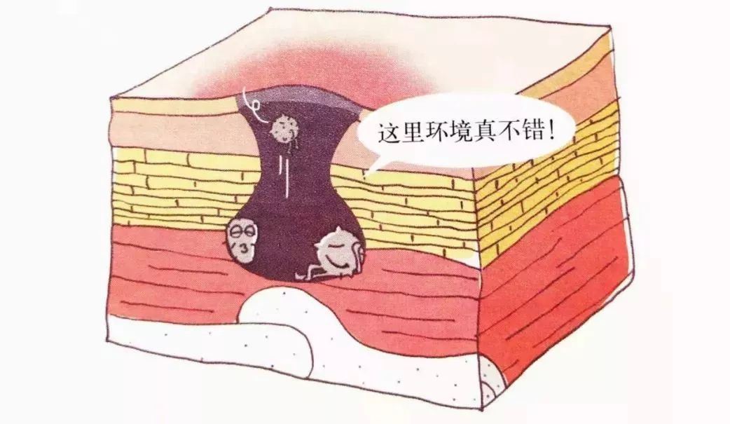 伤口化脓是什么原因？_刘宁_副主任医师_爱问健康