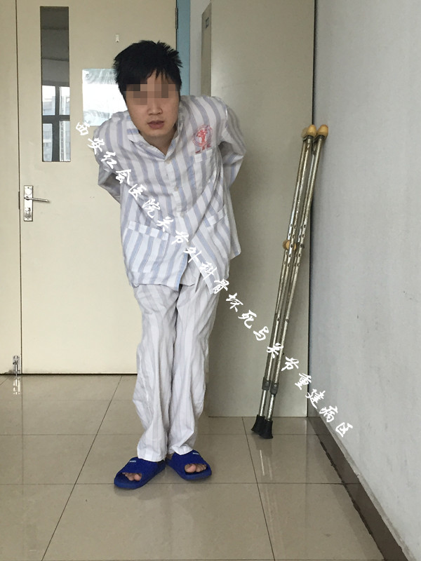 红会医院关节外科骨坏死与关节重建病区成功救助25岁"强直性脊柱炎"帅