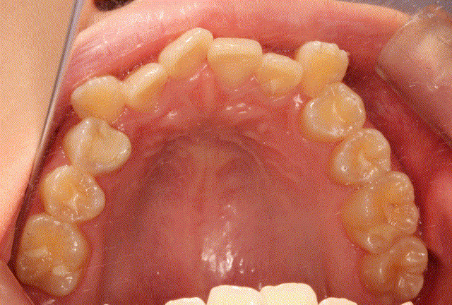 1例上颌拥挤下切牙先天缺失病例