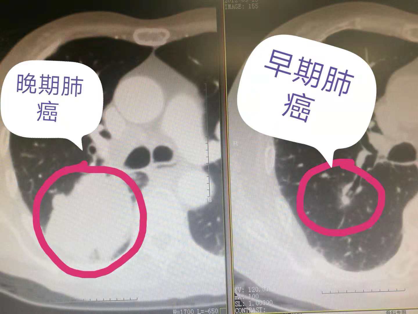死神大人最忠心的仆人,众癌之王——肺癌君最后的告白