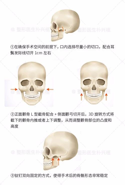 拜托了院长 | 颧骨颧弓在哪里?颧骨和苹果肌怎么区分?_崔荣达__爱问健康