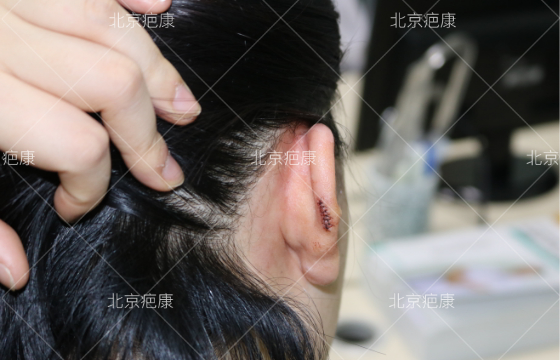 病例分析：重庆陈女士耳廓瘢痕疙瘩