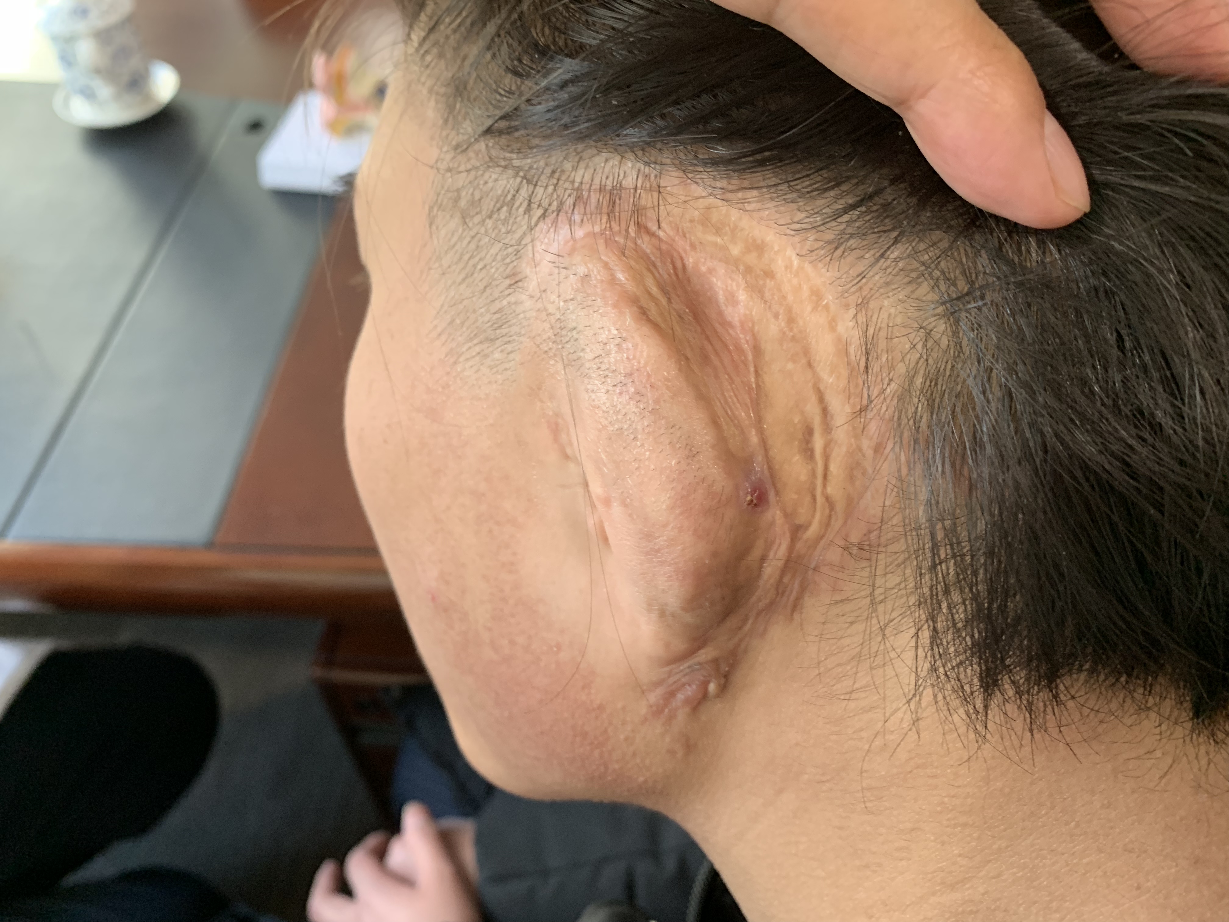 小耳畸形那些事儿(六十六)差别不仅仅是疤痕大小