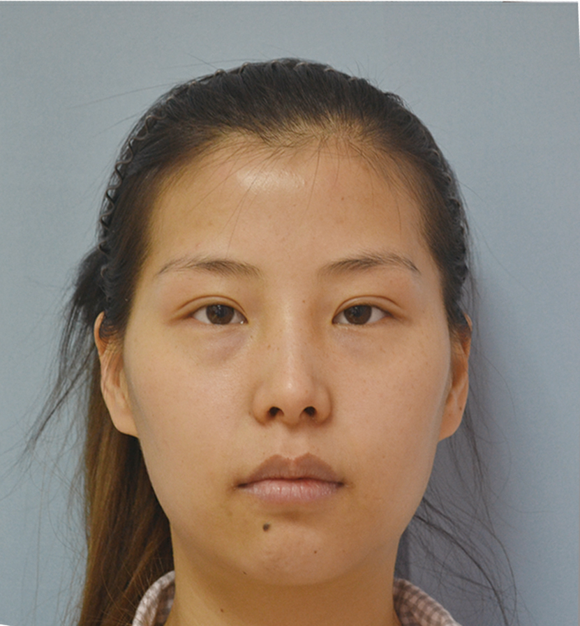 嘉美信真实案例——脂肪填充后我不再需要p图软件了