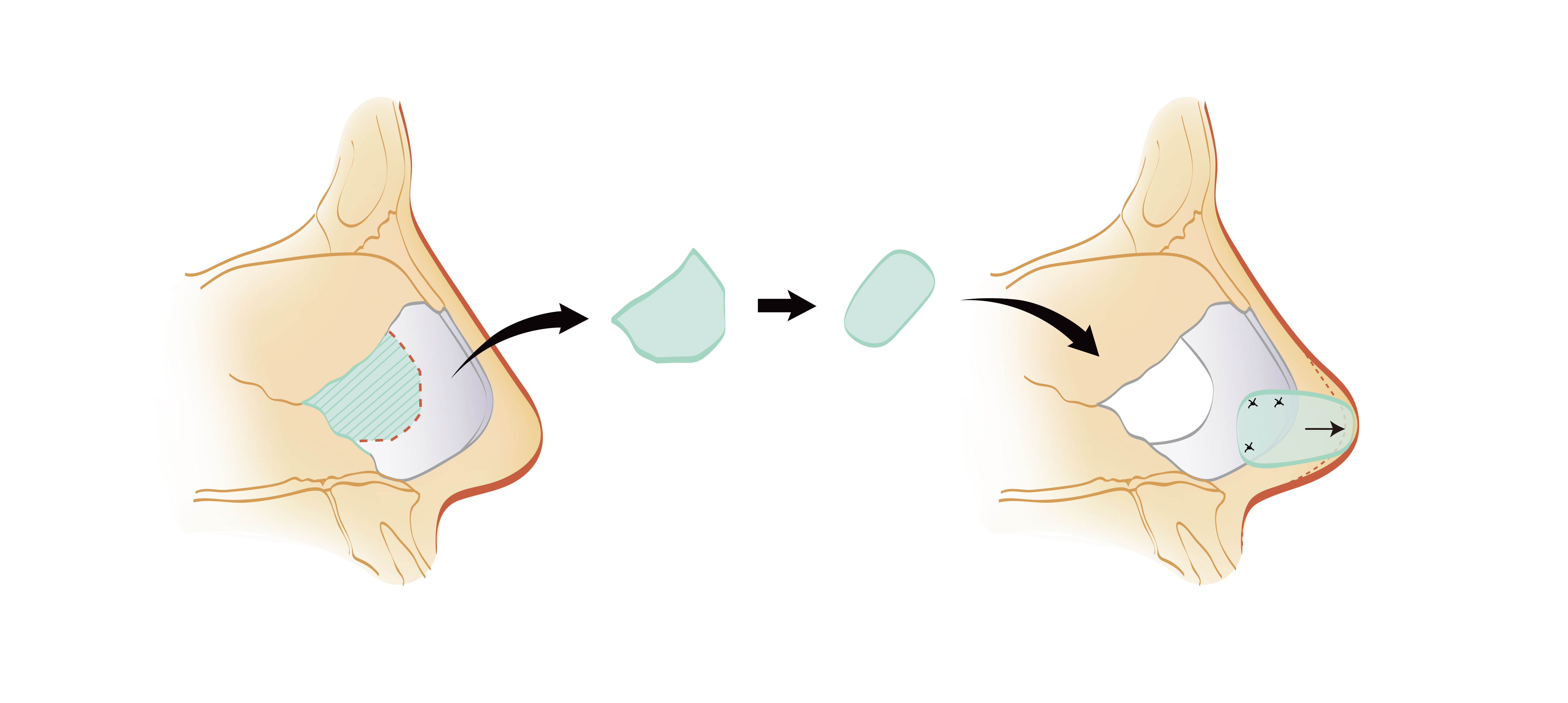 隆鼻首选鼻中隔 ,那鼻中隔你知道在哪吗?
