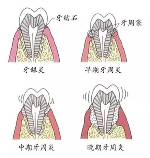 如果不及时治疗,当牙龈炎发展到晚期的时候,它就会慢慢侵入牙周(包括