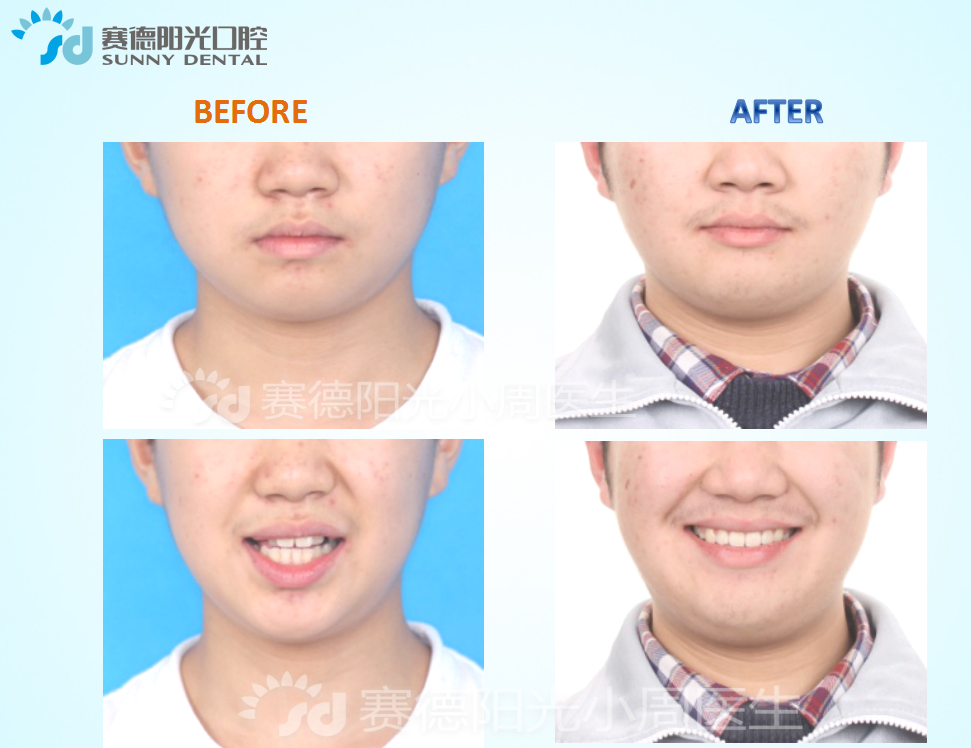 【双期矫治:快速扩弓 矫治】上牙弓狭窄 后牙反 _周绍楠__爱问健康