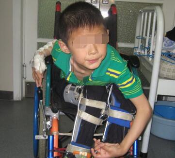 6岁脑瘫孩子肢体障碍,fspr术治疗效果显著