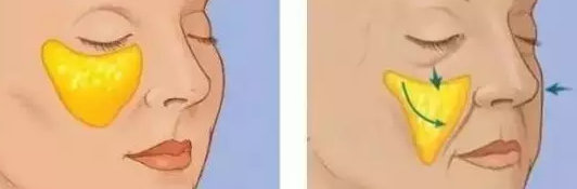 苹果肌下垂