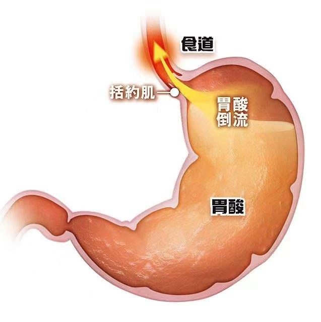 胃酸是怎么回事图片