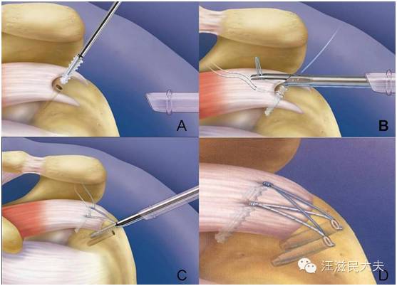 微创手术可以让肩袖和肱骨头破镜重圆,恢复肩关节的稳定和功能,同时也
