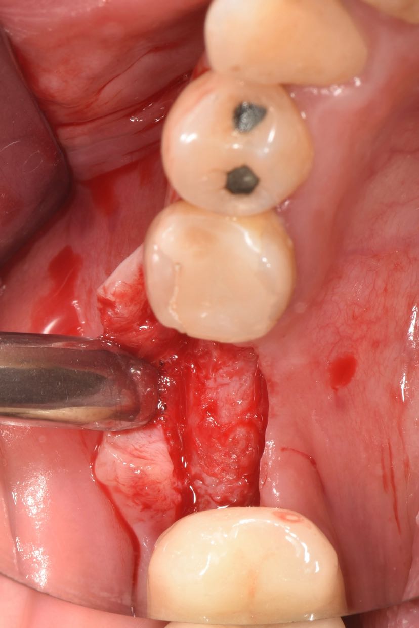 大量牙结石牙菌斑翻瓣拆除原来的种植牙冠口内照片可见颊侧牙龈红肿