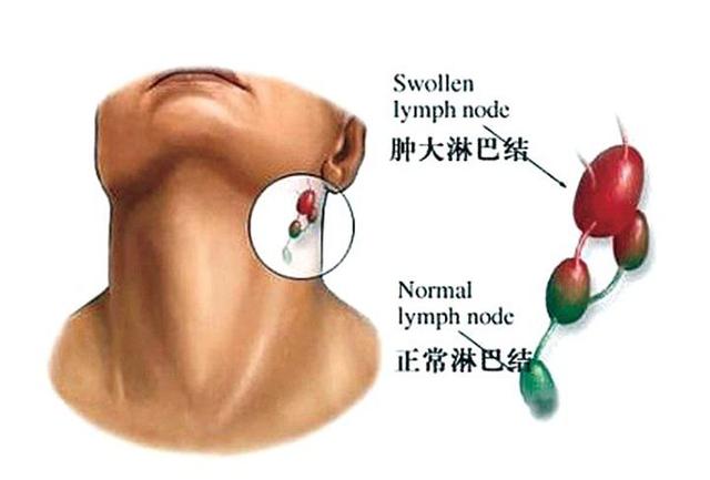 淋巴瘤是什么引起的图片