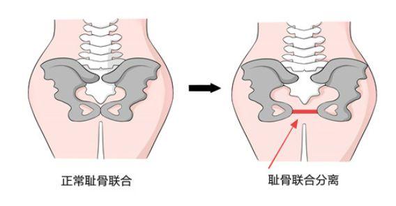 有的准妈妈耻骨联合处先天比较薄弱,或者因为突然改变动作,用力过猛或