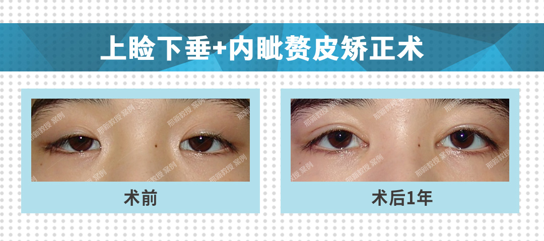 3上睑下垂 内眦赘皮矫正术.jpg