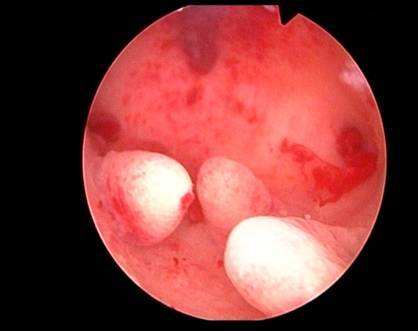 子宫内膜增生宫腔镜图片