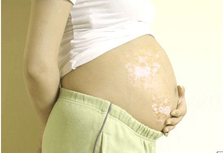 什么是窄谱紫外线治疗皮肤科普：窄谱中波紫外线使用须知_https://www.jmylbn.com_新闻资讯_第3张