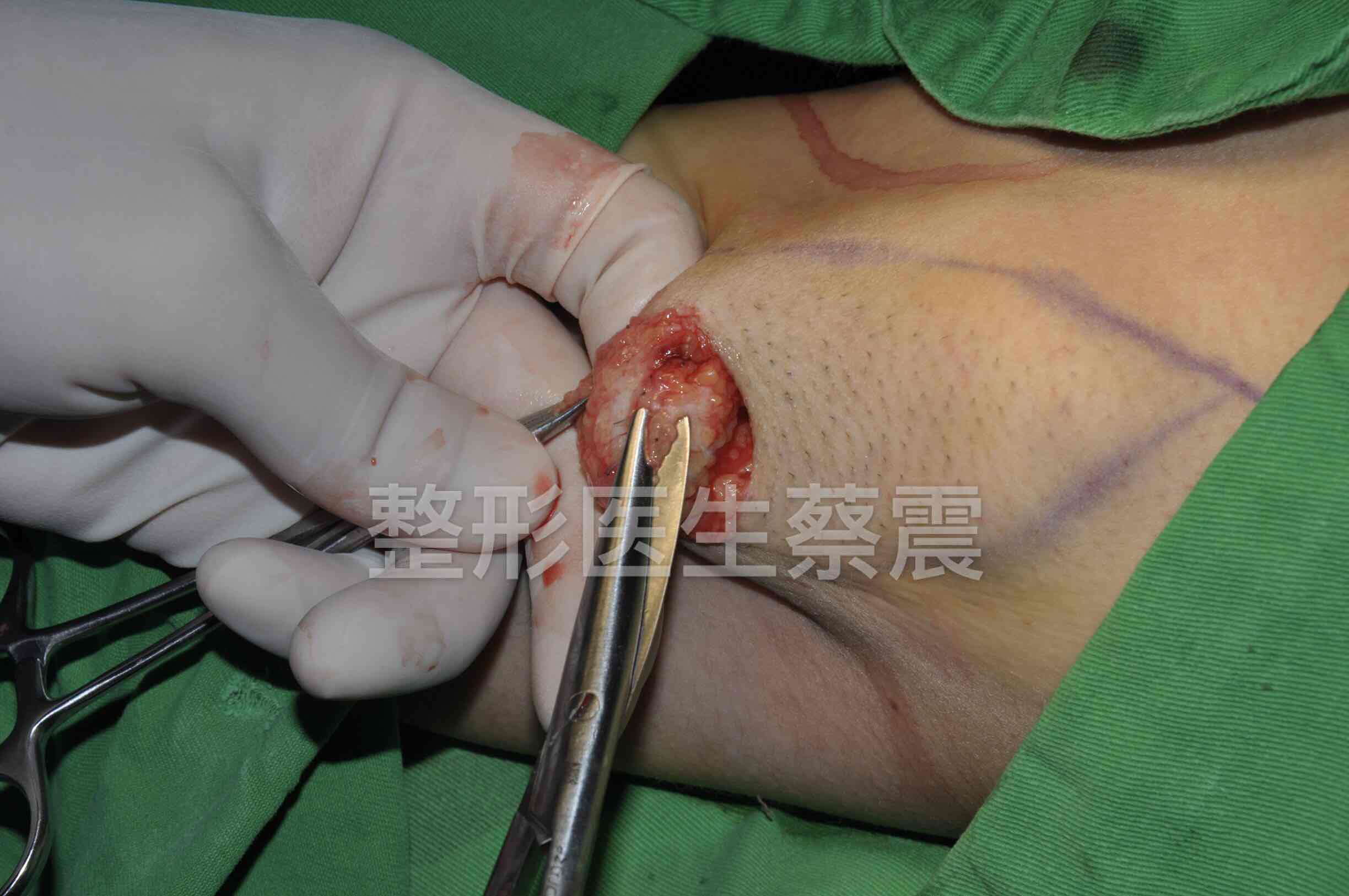 图解腋臭(臭汗症)的整形外科微创手术治疗