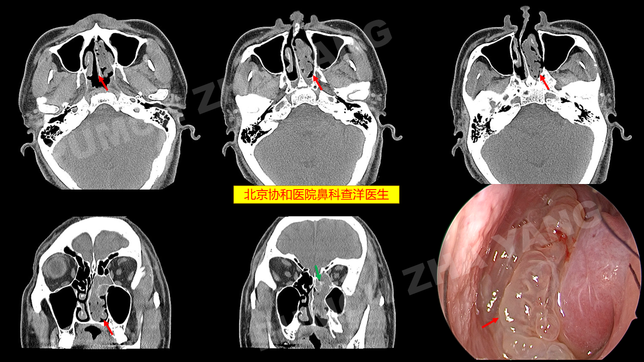 鼻内翻性乳头状瘤的典型外观形态
