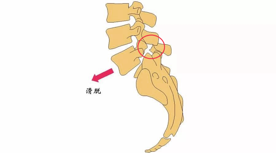 腰椎小关节在哪里图片图片