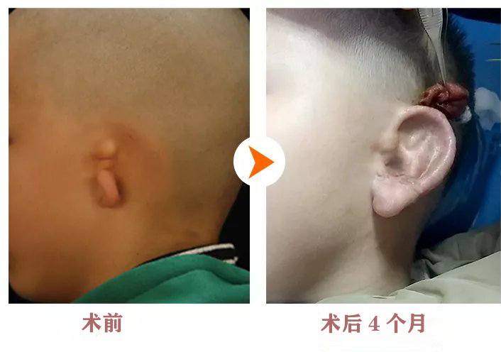 畸形耳朵手术再造多少钱_畸形耳朵手术再造要多少钱_耳朵畸形再造手术