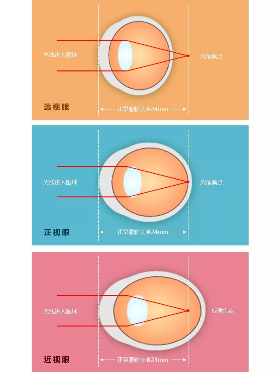 每一个孩子的"远视储备"都是宝藏,用完就近视了,你知晓吗?