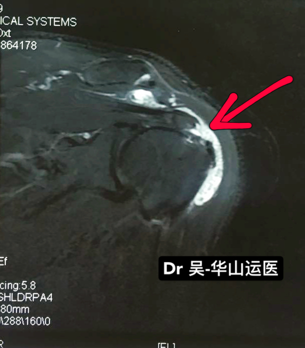 肩袖损伤核磁图片