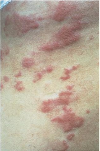 血管炎荨麻疹症状图片