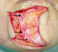 皮下缝合用什么线常用的疤痕切除术切口减张技术_https://www.jmylbn.com_新闻资讯_第2张