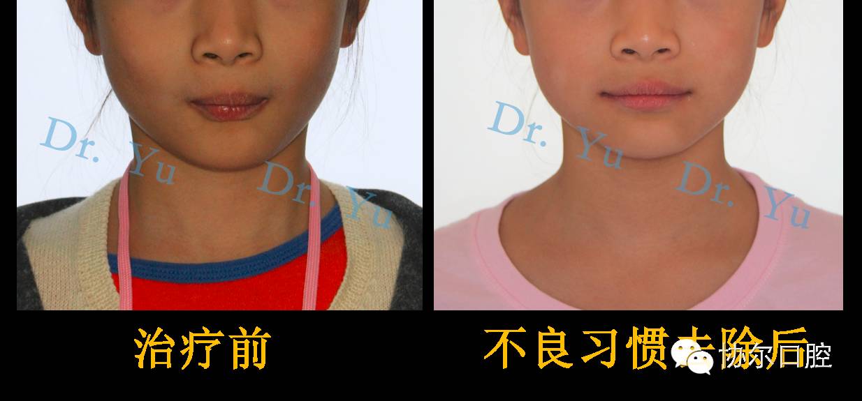 儿童早期咬合管理,为孩子的生长发育加分