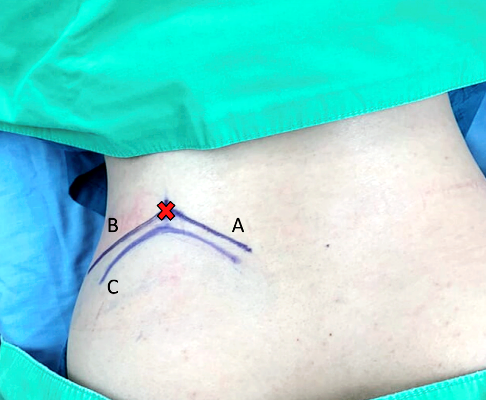 手术技术丨椎间孔镜治疗高髂嵴l5-s1椎间盘突出症_江伟_副主任医师