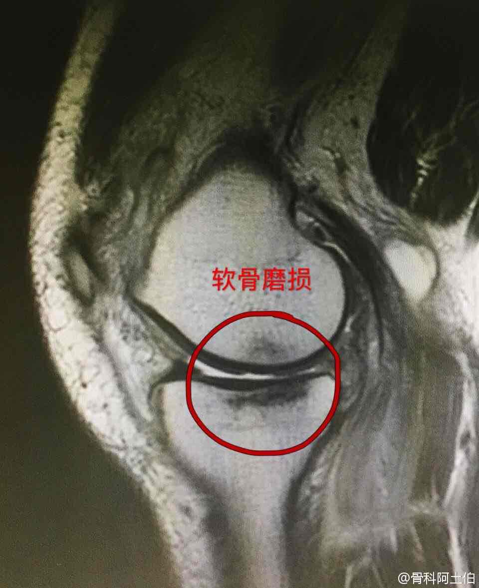明确半月板三度损伤该怎么处理!