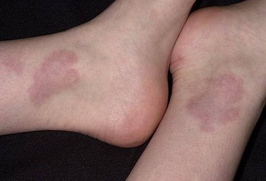 环状肉芽肿的主要特征包括:症状环状肉芽肿好发于青年人和儿童,女性患