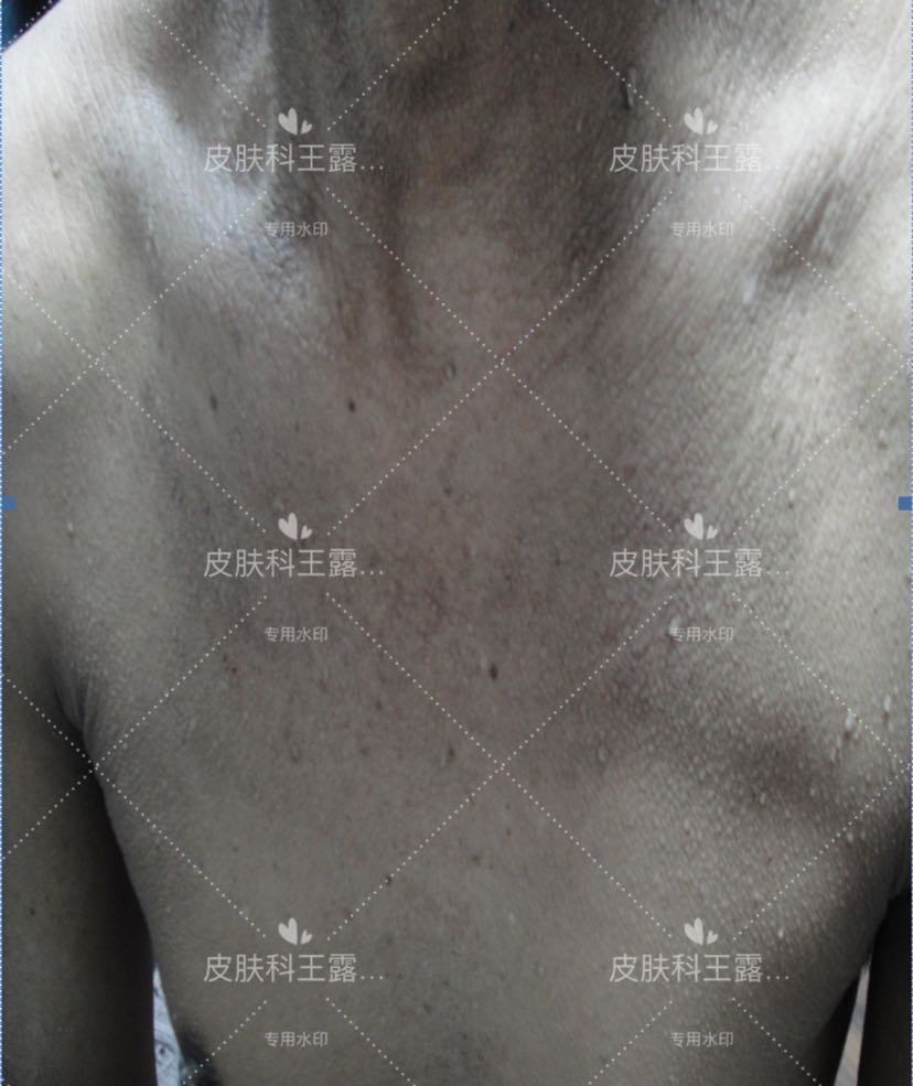 恶性黑棘皮病1例～皮肤病，不至于皮肤_王露_副主任医师_爱问健康